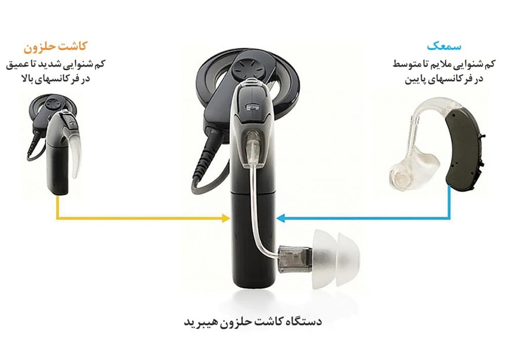 کاشت حلزون