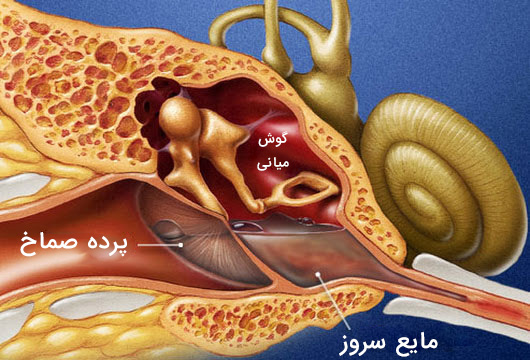 درمان مایع گوش میانی