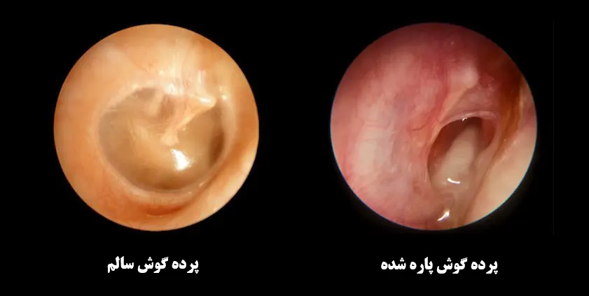 19132073 پارگی پرده گوش روش های درمان پارگی پرده گوش