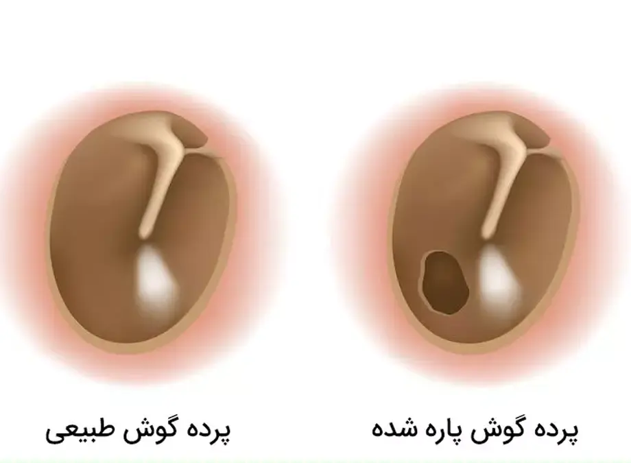 19132074 پارگی پرده گوش علائم و نشانه های پارگی پرده گوش