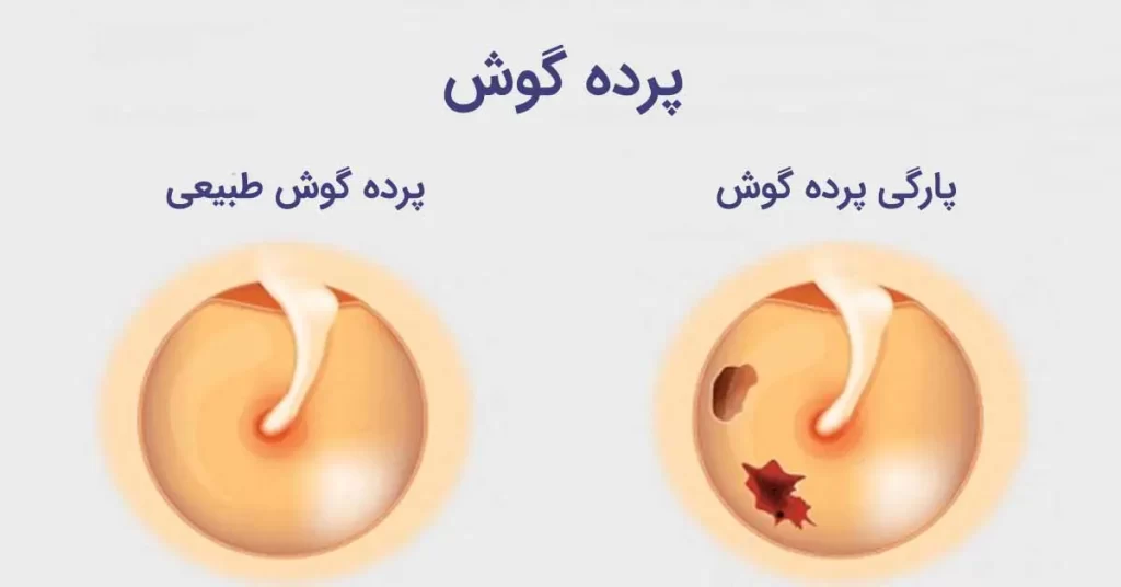 19132075 پارگی پرده گوش روند درمان پارگی پرده گوش